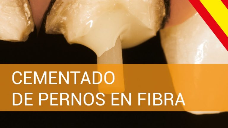 Cementado de Pernos de Fibra de Vidrio