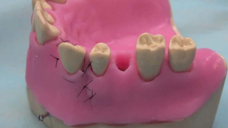 Regeneracion tisular guiada y relleno de alveolo en maniqui