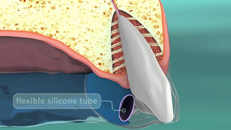 Sistema de Ortodoncia Aerodentis