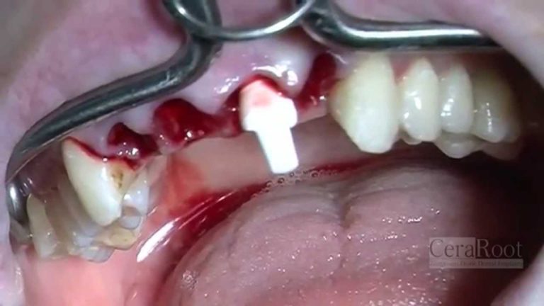 Cirugia de los 4 incisivos superiores y colocacion de implantes de Zirconio