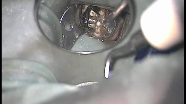 Eliminacion de perno muñon colado con ultrasonido