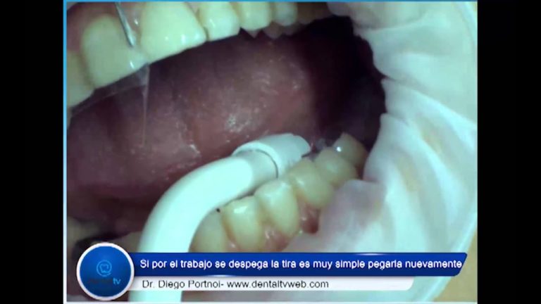 Como reparar una carilla dental de composite-Paso a paso