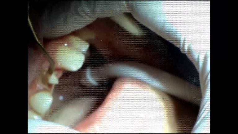 Como tomar una impresion para una corona