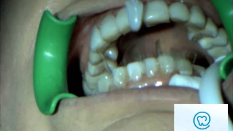 Como hacer unas Carillas de Composite rapido y muy facilmente Paso a Paso