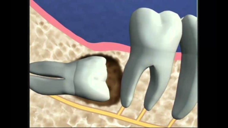 3 eros. molares o muelas de juicio