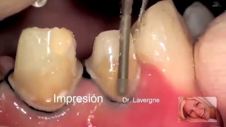 Estetica y Coronas dentales de Porcelana: Desgastes Perifericos