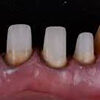 muñon dental dentaltvweb