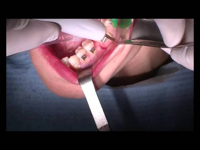 Corticotomias para acelerar el tratamiento de ortodoncia