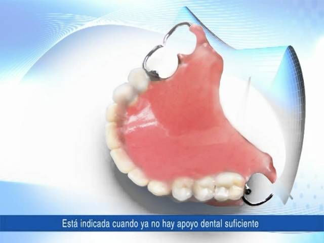 Protesis dental removible