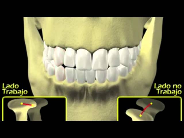 Oclusion dental mutuamente protegida