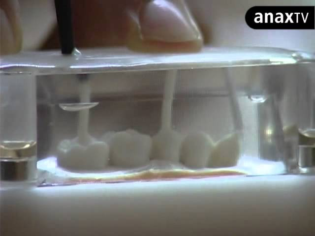 Como hacer restauraciones con la tecnica de injectado de composite fluido