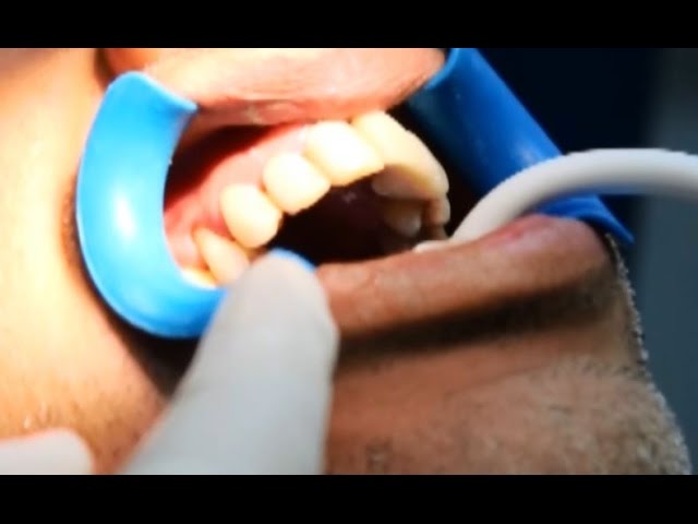 Como hacer carillas dentales de composite en boca