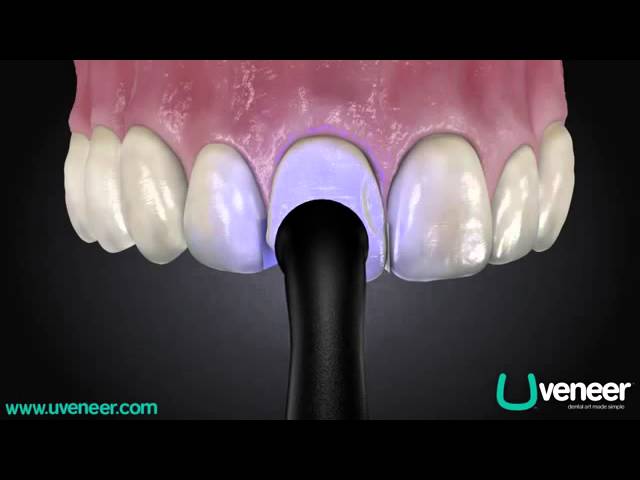 Como trabajar con el sistema de carillas dentales U Veneer