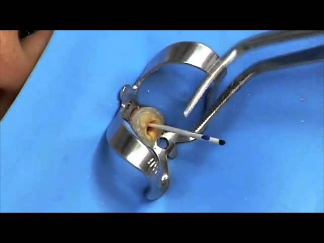 Implantacion de PERNOS INTRA-RADICULARES