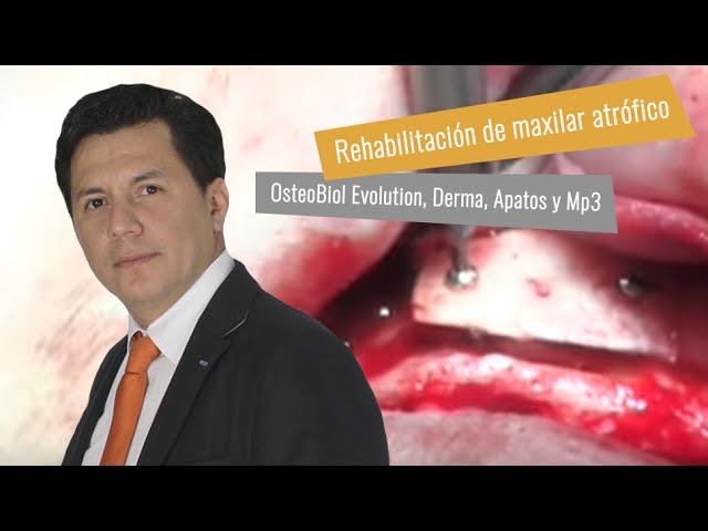 Rehabilitación maxilar atrófico con Membrana Evolution y Derma; Hueso Apatos y MP3.