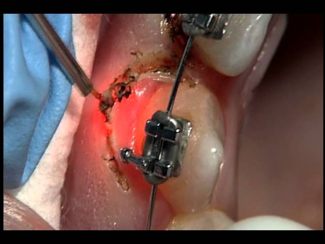 Gingivectomia alrededor de Brackets con laser AMD