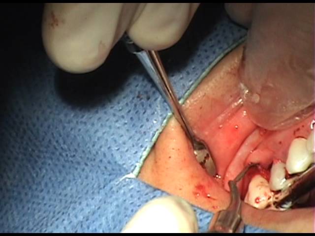 Alargamiento de corona dental a bisel interno