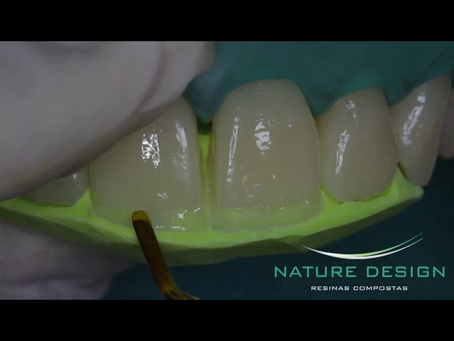 Cerramiento de distema dental y aumento incisal