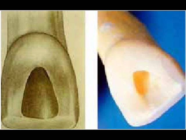Acceso a camara pulpar en dientes anteriores