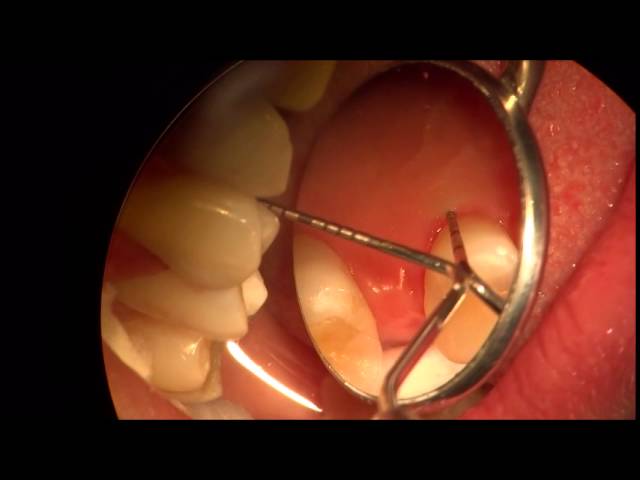 Diagnostico de Fracturas Dentales Verticales