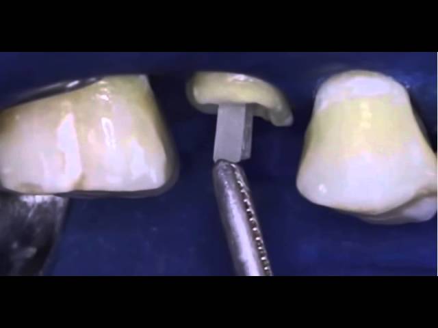 Poste de fibra de vidrio y nucleo tipo Core. Protocolo de preparacion y cementado