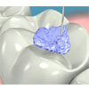 sellador de fosas y fisuras dentaltvweb