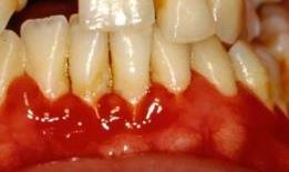 gingivitis dentaltvweb