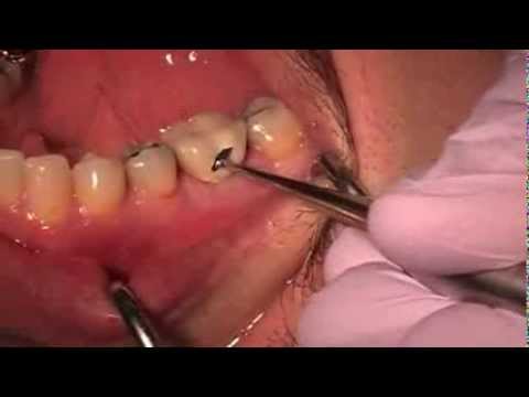 Como extraer muy facilmente una corona dental con el sistema WamKey