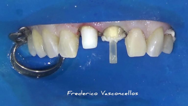 Como hacer un Perno Preformado de Fibra Anatomico