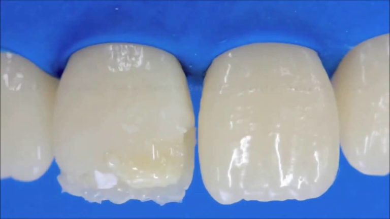 Como restaurar una clase 4 paso a paso