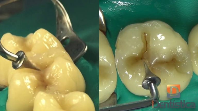 Restauracion en un molar de 2 clases II. Paso a Paso