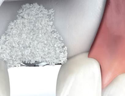 membrana regenaracion de hueso periodontal dentaltvweb