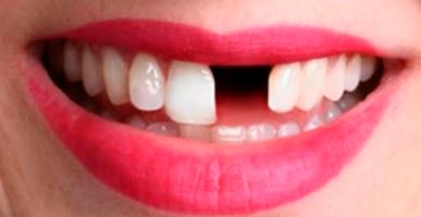 mujer mayor con perdida de dientes