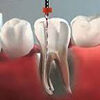 varios endodoncia icono dentaltvweb