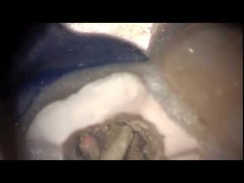 Reparacion de una perforacion en un molar superior