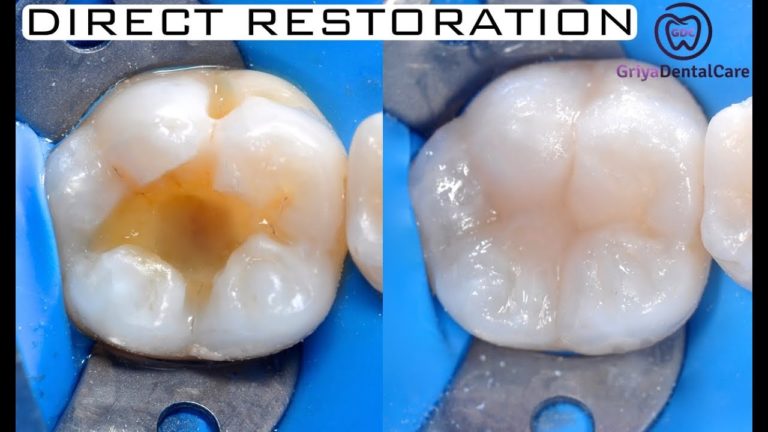 Reemplazo de una amalgama filtrada con Caries por Composite Dental- Paso a Paso