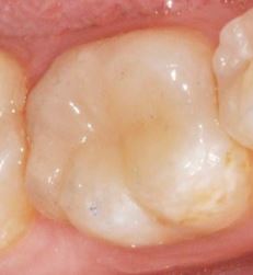 restauracion dental dentaltvweb