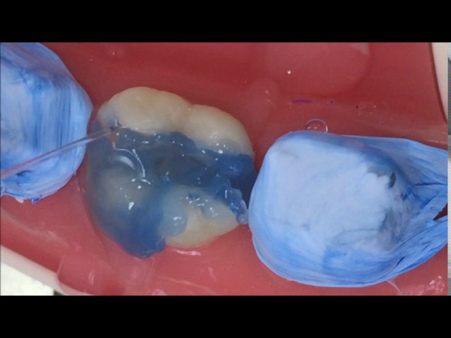Como hacer un onlay en el consultorio con composite. Paso a Paso