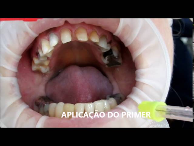 Rehabilitacion estetica en ceramica- Cementado