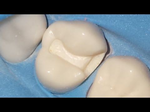 Como tener un buen contacto proximal dental en una Clase II