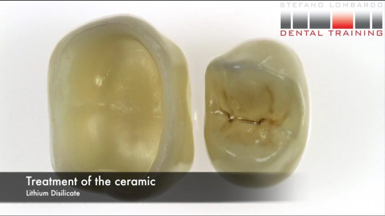Cementado de coronas dentales de ceramica con adhesivo dual. Paso a Paso