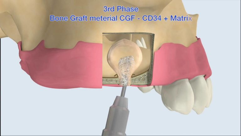 Tecnica IPG-DET: enfoque innovador de la colocacion de implantes e injertos en el seno Animacion 3D Paso a Paso