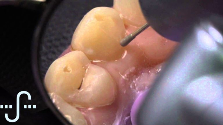 Tallado para Carillas Dentales Palatinas