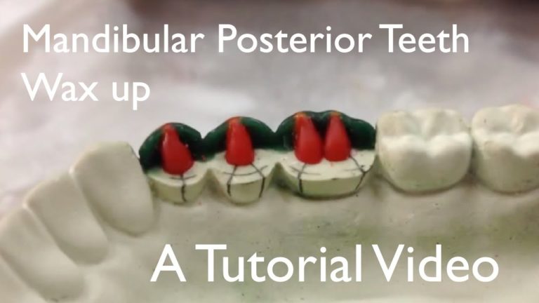 Encerado de los dientes posteriores inferiores. Paso a paso