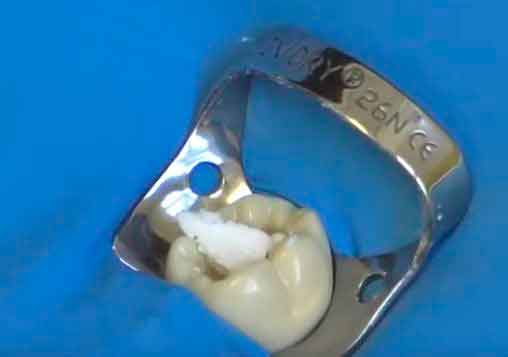 Como hacer un recubrimiento pulpar con hidroxido de calcio e IRM paso a paso