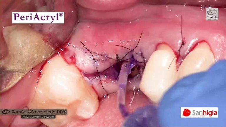 Cicatrización luego de la colocación de un implante dental con PERIACRYL