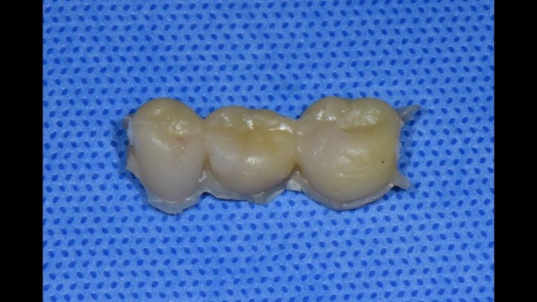 Como fabricar facilmente un puente dental provisorio