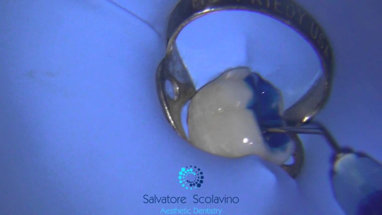 Como hacer una cara oclusal de un molar con la técnica de estampado dental. Paso a paso