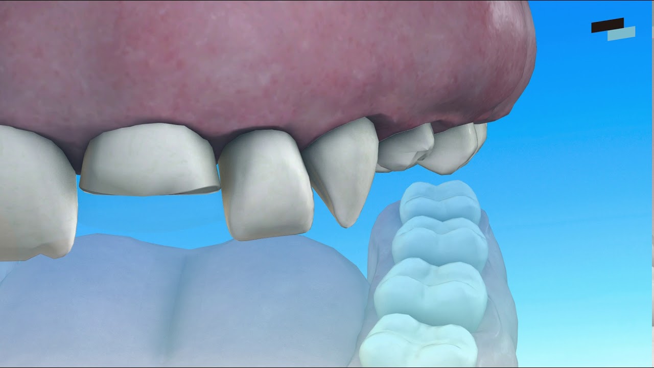 Clasificacion de las Fracturas Dentales