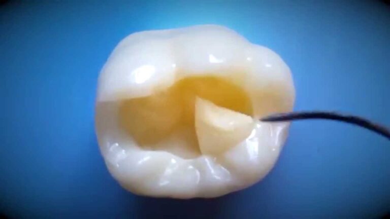 Como restaurar una clase 1 en un molar paso a paso